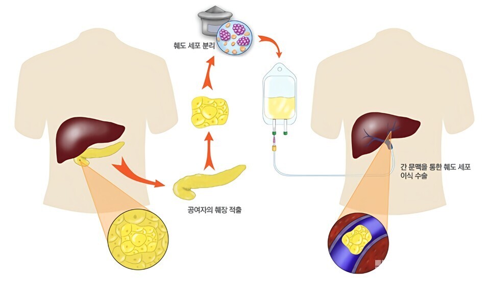 Method of islet transplantation (provided by Samsung Seoul Hospital)