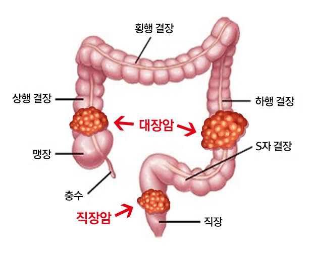 结肠癌直肠癌(图片:韩国胃肠内窥镜学会)