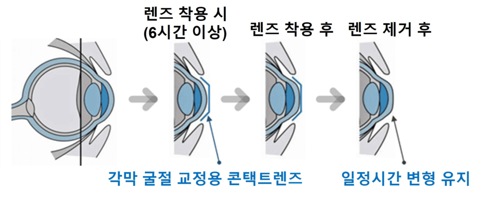 角膜屈折矯正用コンタクトレンズの作用原理及び使用目的